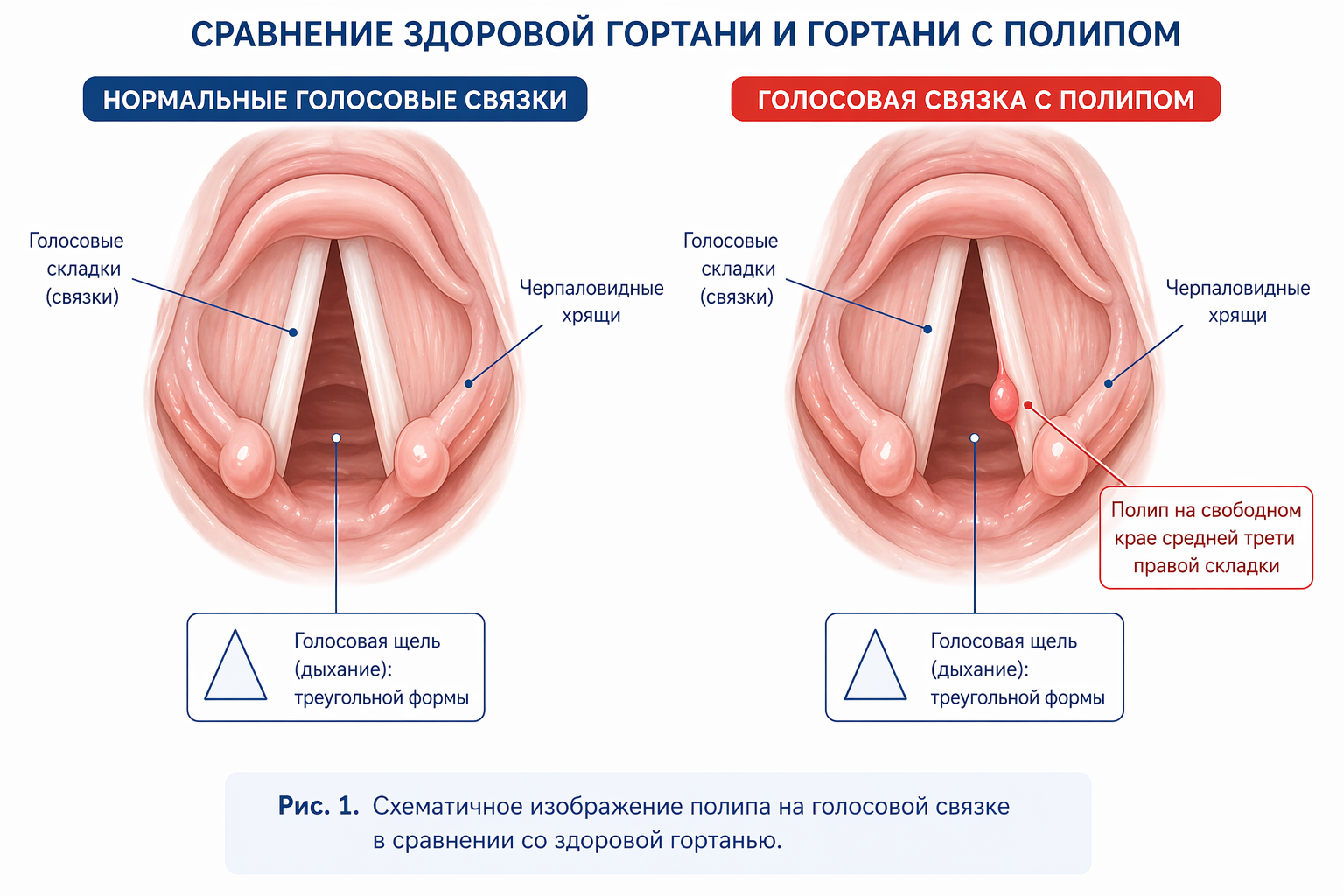 Сравнение здоровой гортани и гортани с полипом